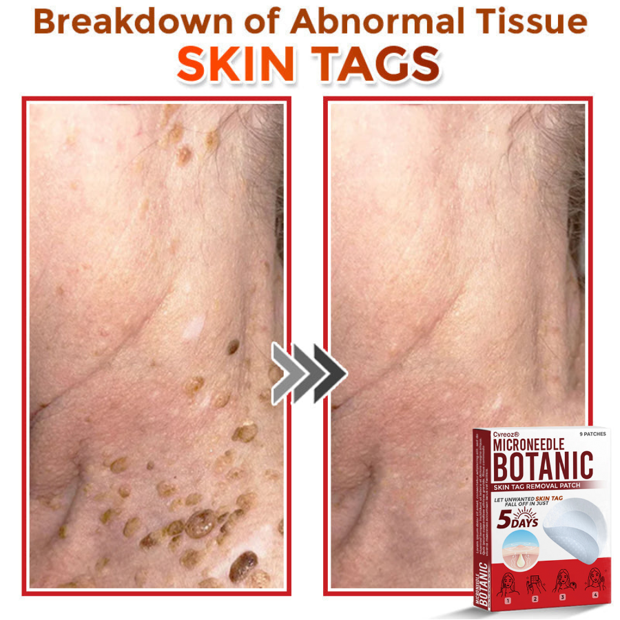 Cvreoz® MicroNeedle Botanic Skin Tag Removal Patch 🇺🇸 Made in the USA