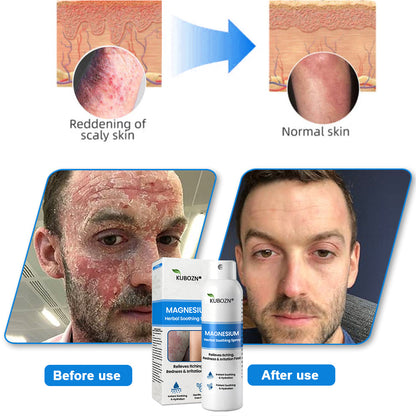 ⚕️ KUBOZN® Magnesium Herbal Psoriasis Spray ⚡3-MINUTE RELIEF