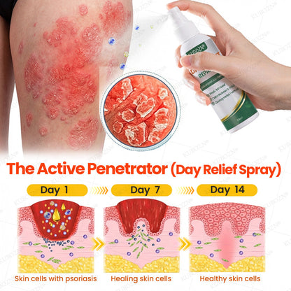 KUBOZN® Psoriasis Day & Night Repair System - 100% Steroid-Free Relief Duo for Plaques, Scaling & Itch