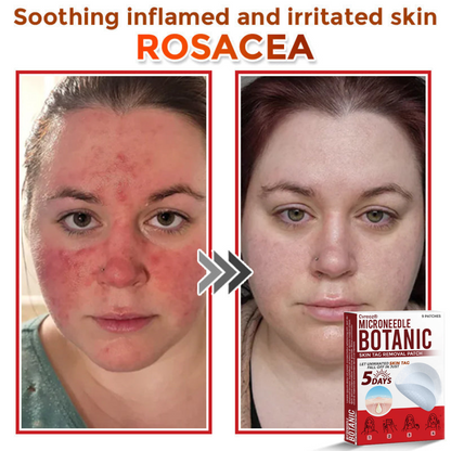 Cvreoz® MicroNeedle Botanic Skin Tag Removal Patch 🇺🇸 Made in the USA