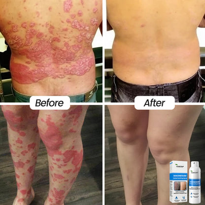 ⚕️ KUBOZN® Magnesium Herbal Psoriasis Spray ⚡3-MINUTE RELIEF