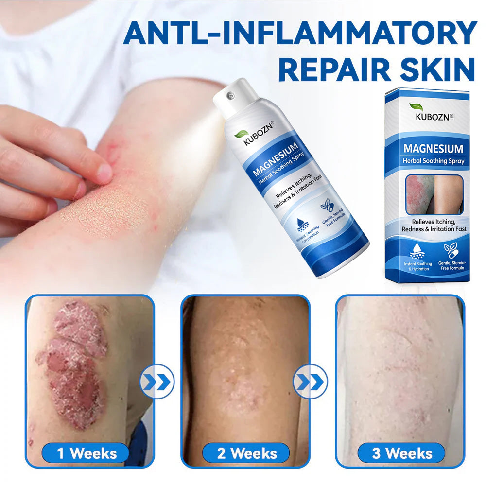 𝗢𝗳𝗳𝗶𝗰𝗶𝗮𝗹 𝗦𝘁𝗼𝗿𝗲 | KUBOZN® Magnesium Herbal Psoriasis Spray