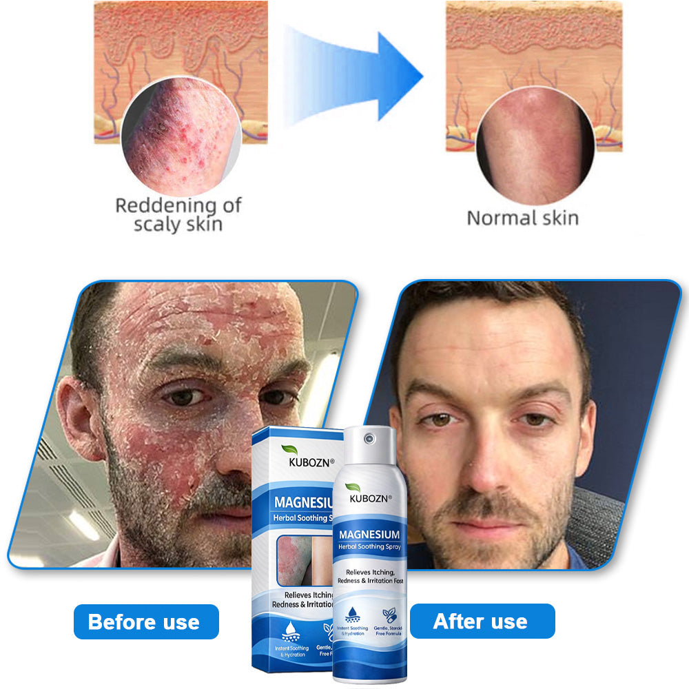 𝗢𝗳𝗳𝗶𝗰𝗶𝗮𝗹 𝗦𝘁𝗼𝗿𝗲 | KUBOZN® Magnesium Herbal Psoriasis Spray