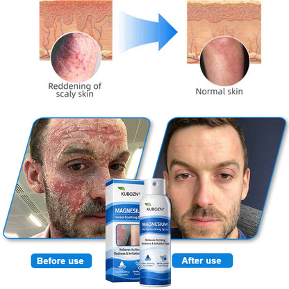 𝗢𝗳𝗳𝗶𝗰𝗶𝗮𝗹 𝗦𝘁𝗼𝗿𝗲 | KUBOZN® Magnesium Herbal Psoriasis Spray