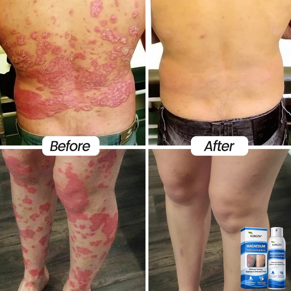 𝗢𝗳𝗳𝗶𝗰𝗶𝗮𝗹 𝗦𝘁𝗼𝗿𝗲 | KUBOZN® Magnesium Herbal Psoriasis Spray