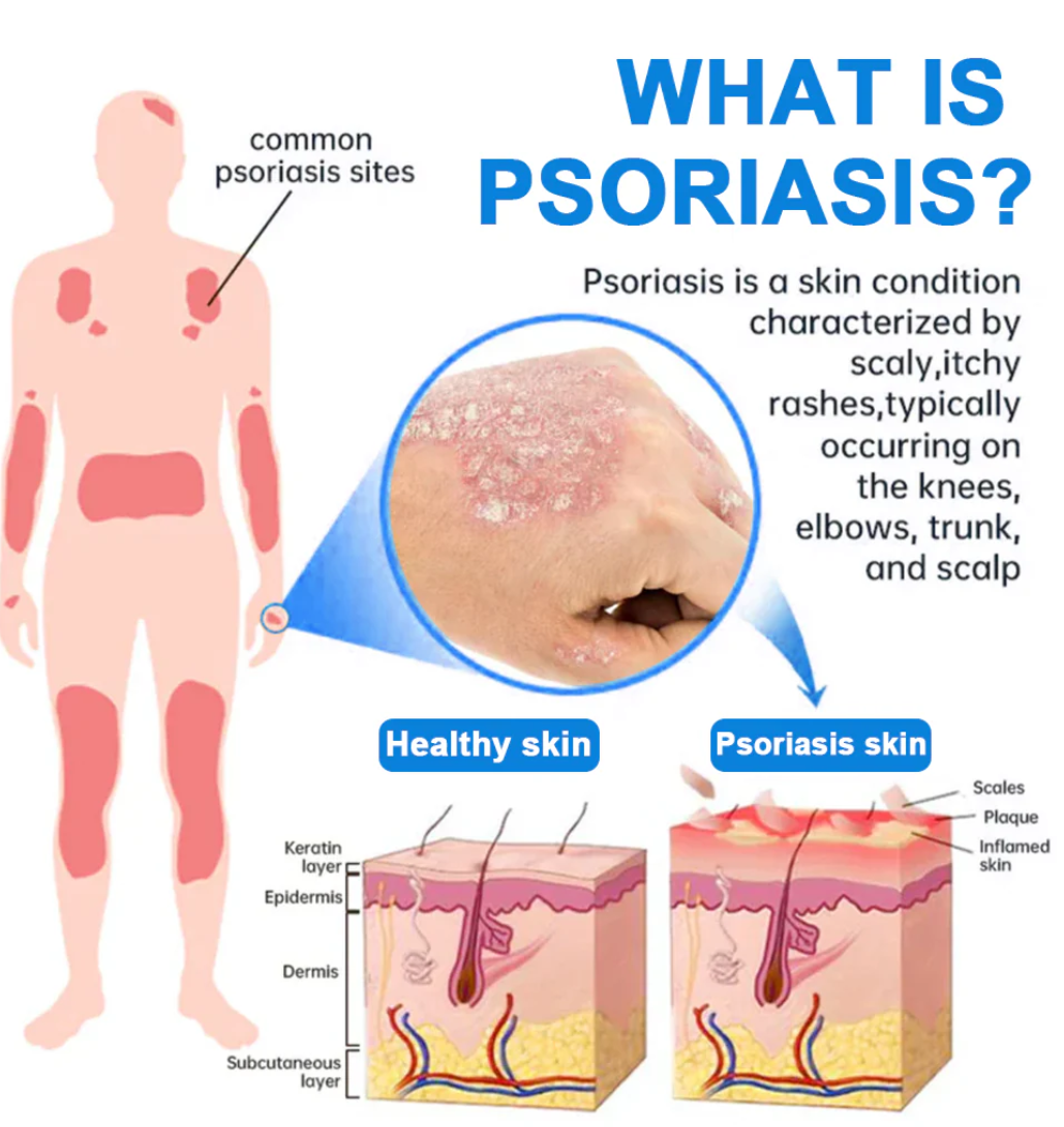 ⚕️ KUBOZN® Magnesium Herbal Psoriasis Spray ⚡3-MINUTE RELIEF